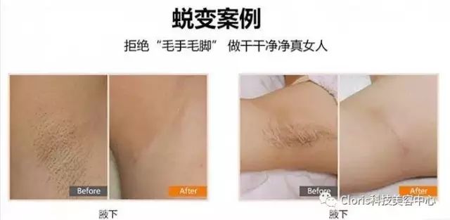 脱毛季节，关于脱毛的最佳时机与注意事项