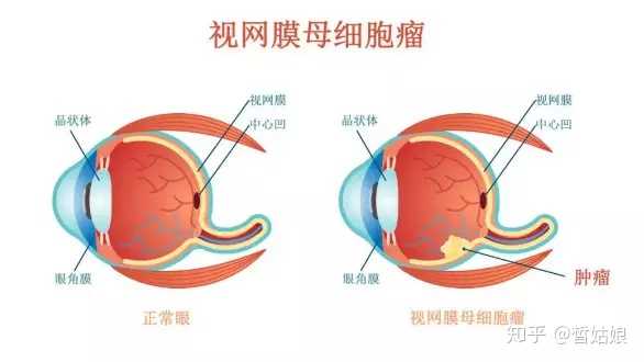 视网膜母细胞瘤与医院的密切关联，一种疾病的深度解读