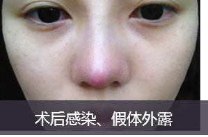 关于整形鼻子的费用，你需要知道的一切
