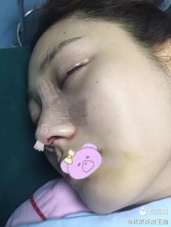 鼻子里肿的就剩一条缝，深度探索鼻部肿胀的原因与应对之策