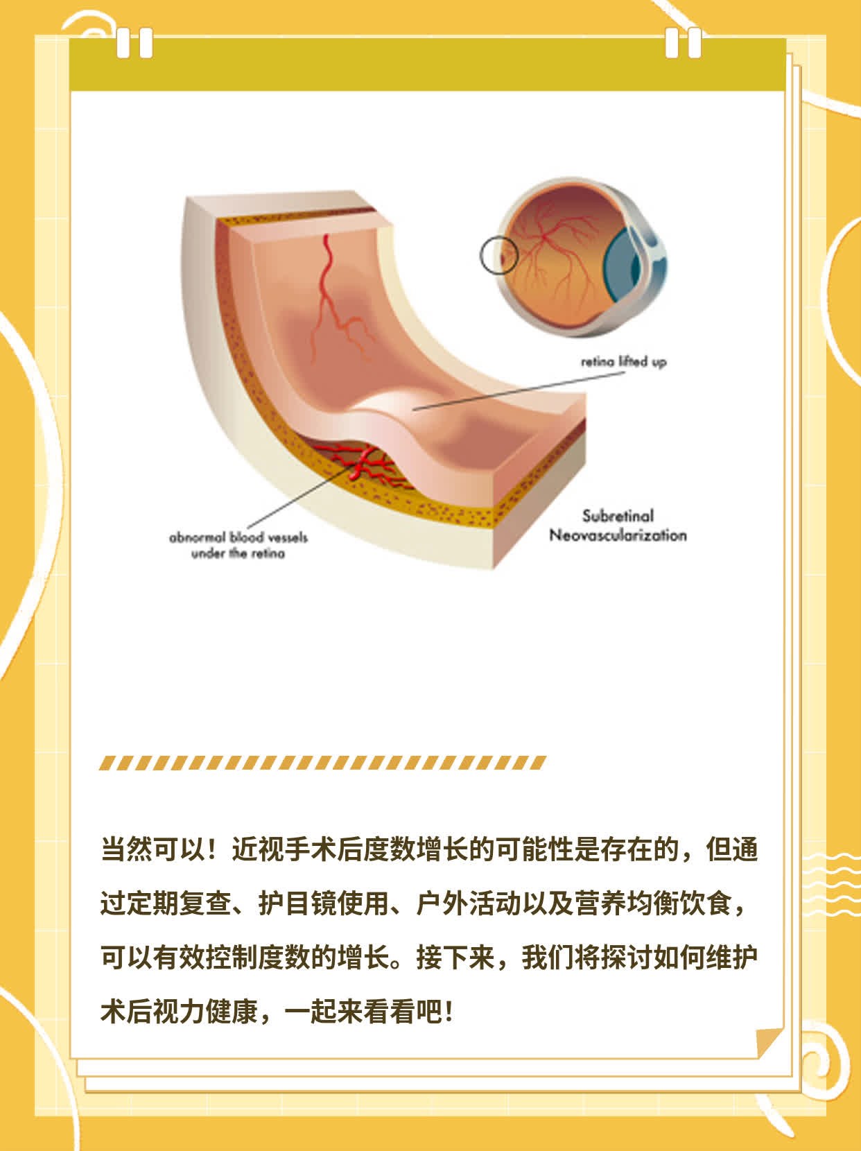 近视眼手术与眼罩，保护眼睛的重要步骤