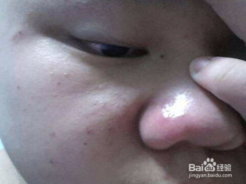 鼻子红肿如何快速消除