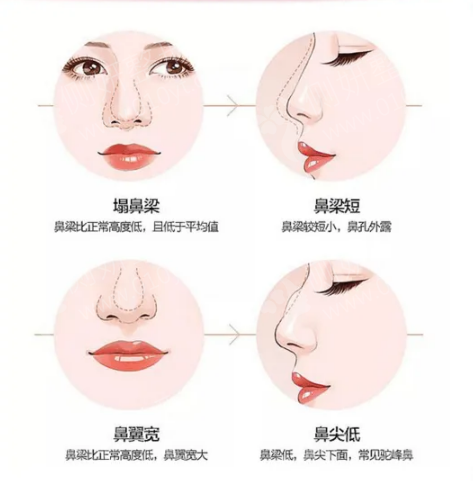 鼻子整形最好的医院——专业、安全、效果的完美结合