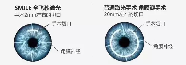全飞秒手术后的眼罩保护，关键一步在视力恢复之旅中的重要性
