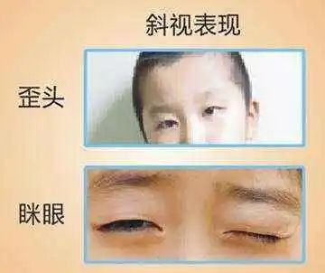儿科斜视专家，守护儿童眼健康的守护者