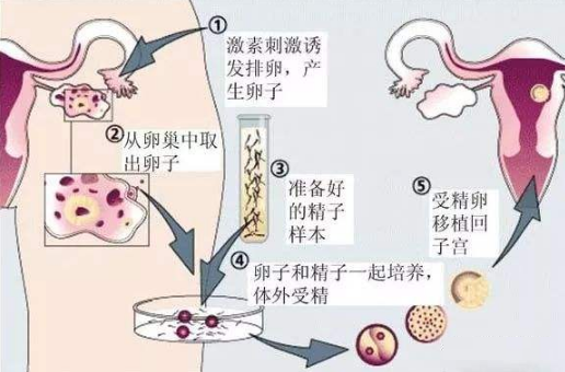 取卵前黄体酮的应用及其重要性